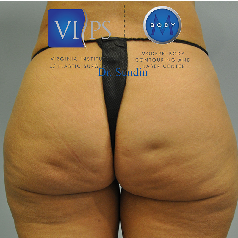 Aveli Before and After | Little Lipo
