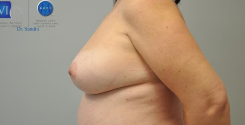 Breast Augmentation With Fat Grafting Before and After | Little Lipo