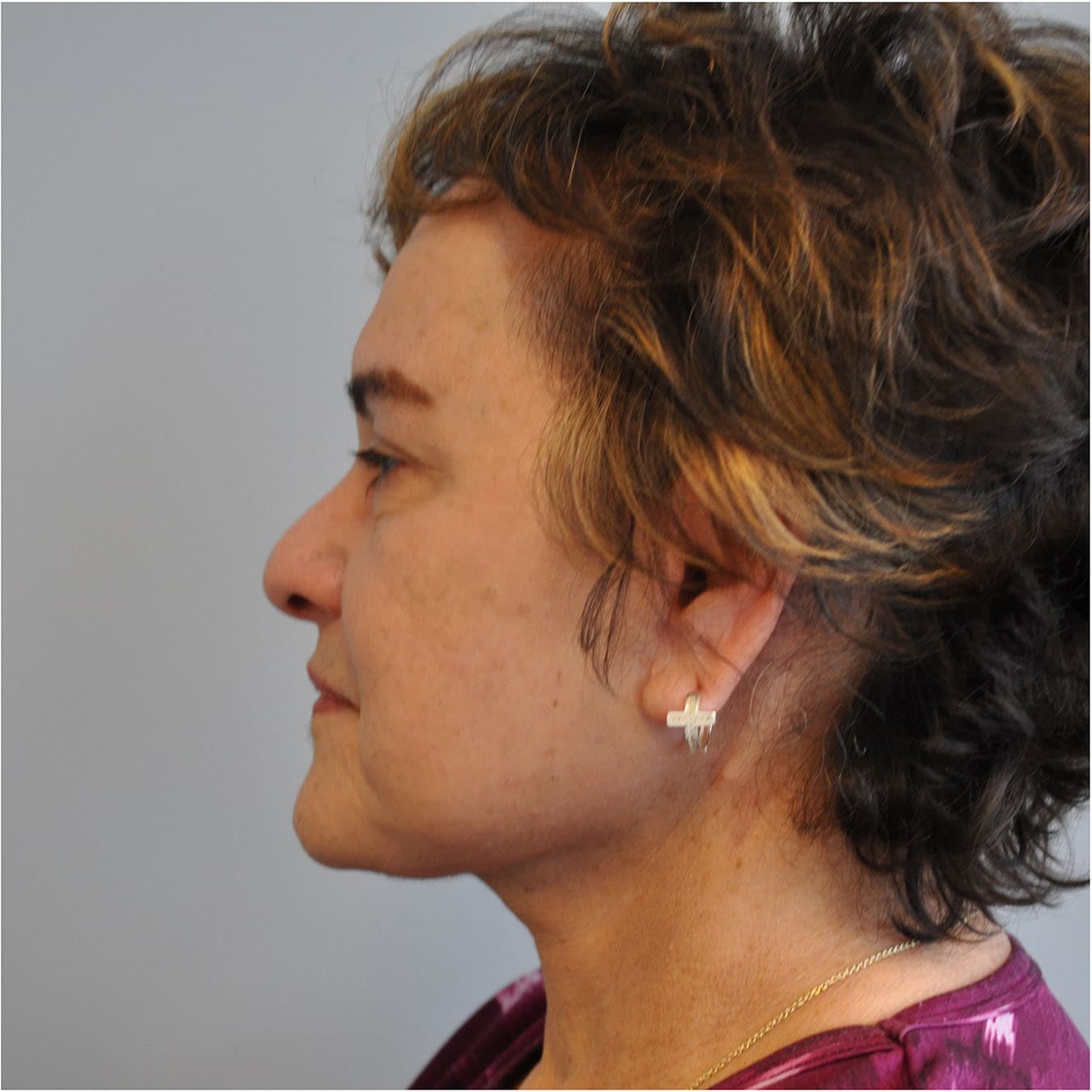 Facelift Before and After | Little Lipo