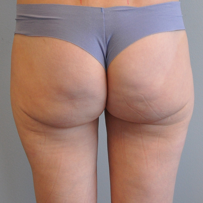 Thigh Liposuction Richmond