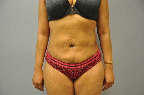 Assisted Liposuction Richmond