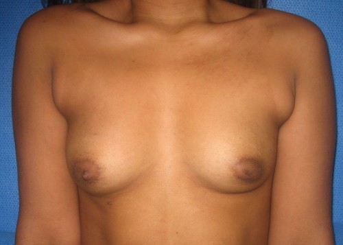Abdomen Liposuction Richmond