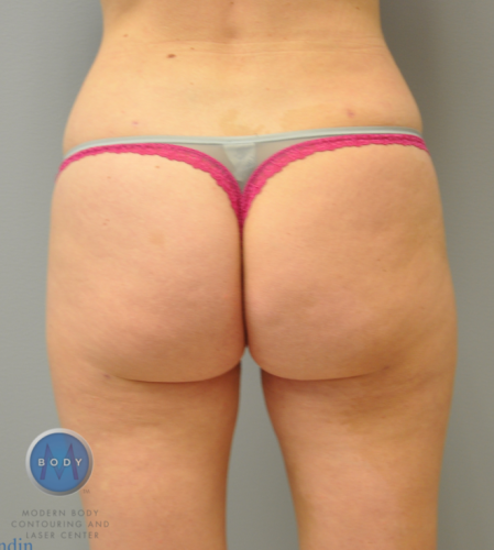 Back Liposuction Richmond