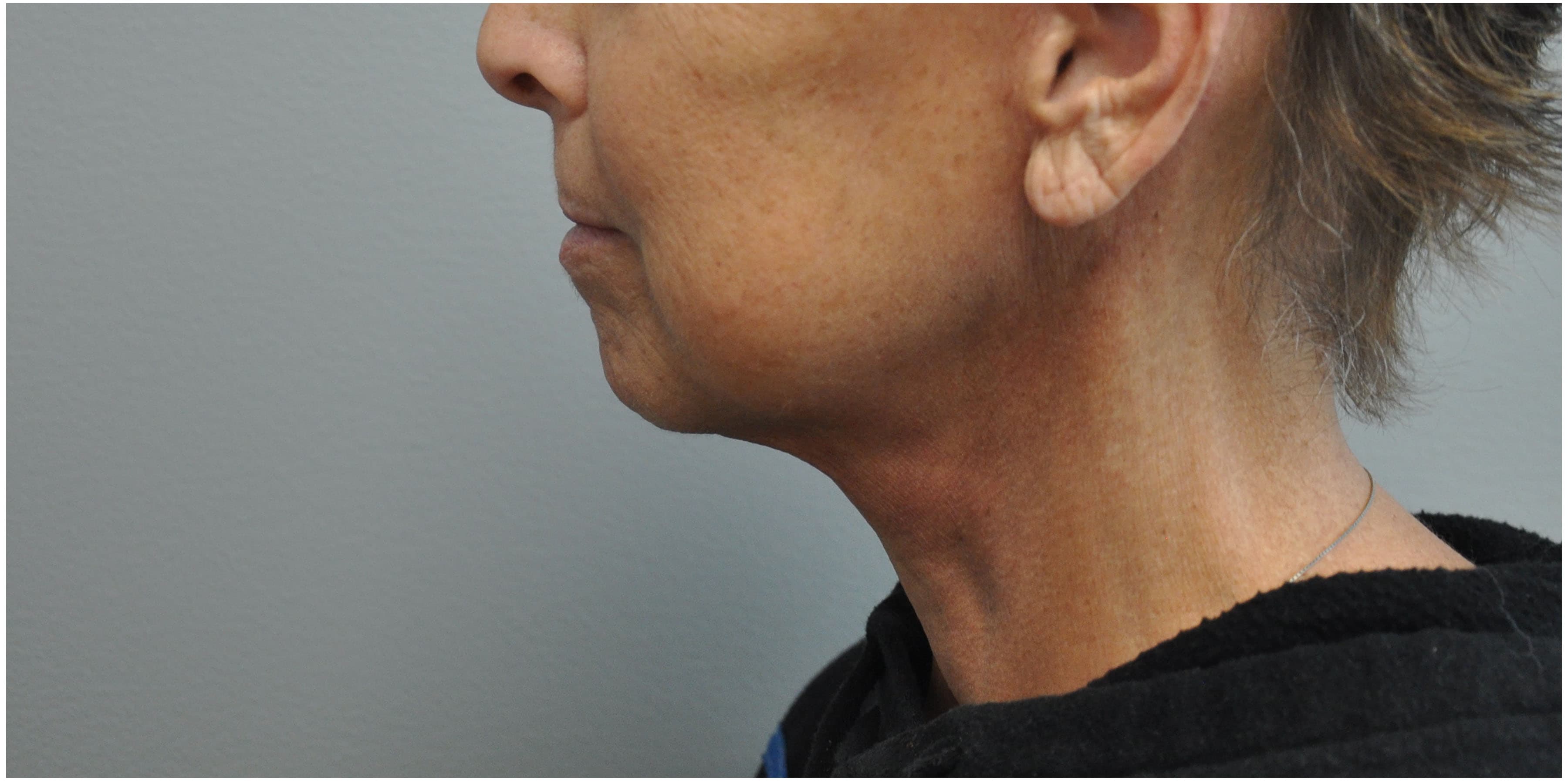 Necklift Before and After | Little Lipo