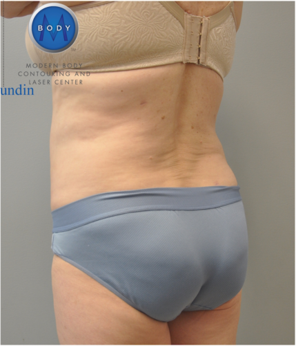 Renuvion J Plasma Before and After | Little Lipo